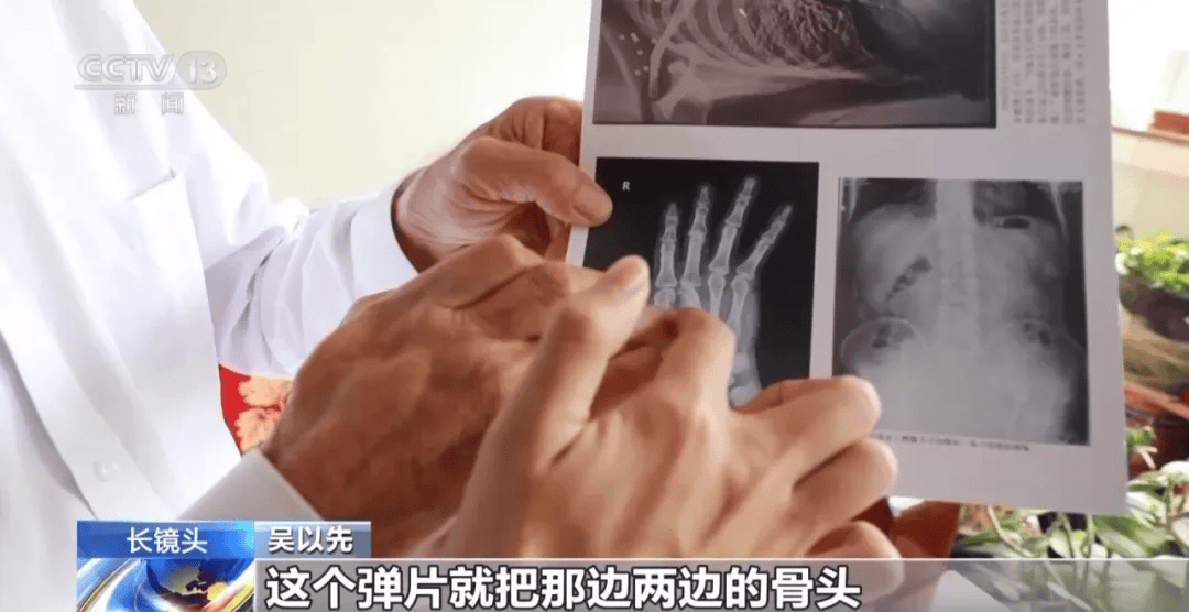 皇冠信用盘可以占几成_“老先生皇冠信用盘可以占几成，您把项链取下来再做CT”